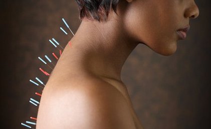 benefits of acupuncture